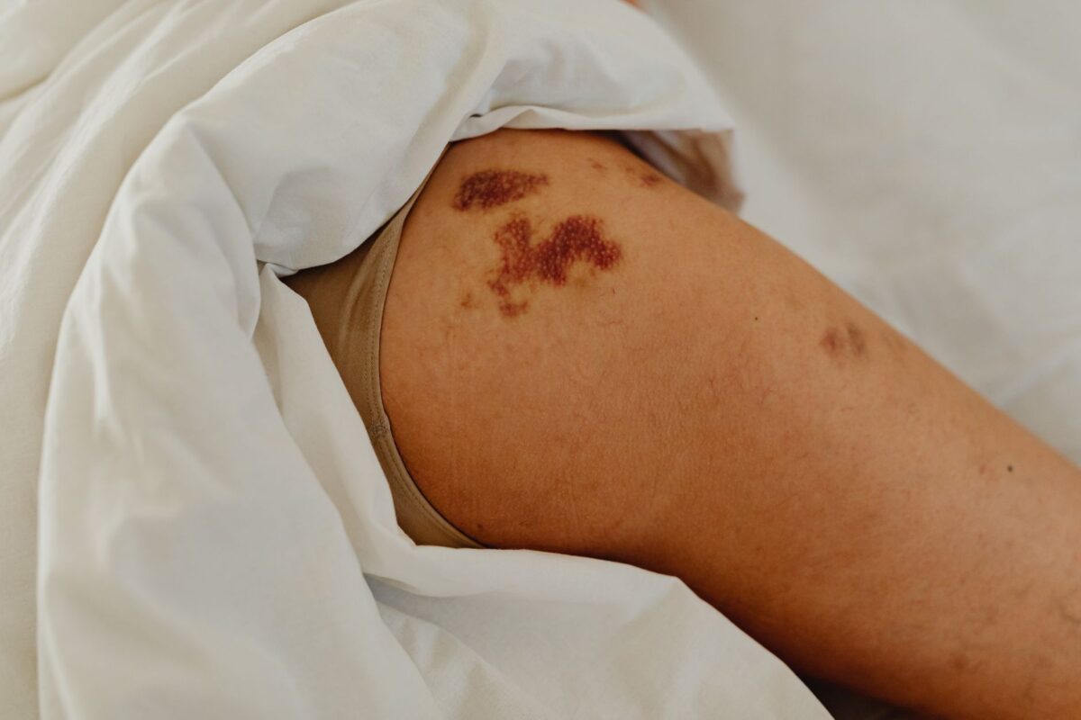 douleur cuisse arrière consulter traitements envisager