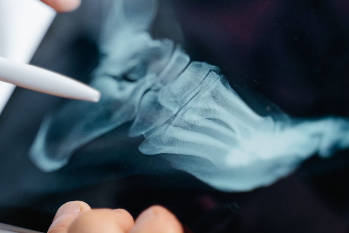 doigt pied cassé maintenant suspecte fracture